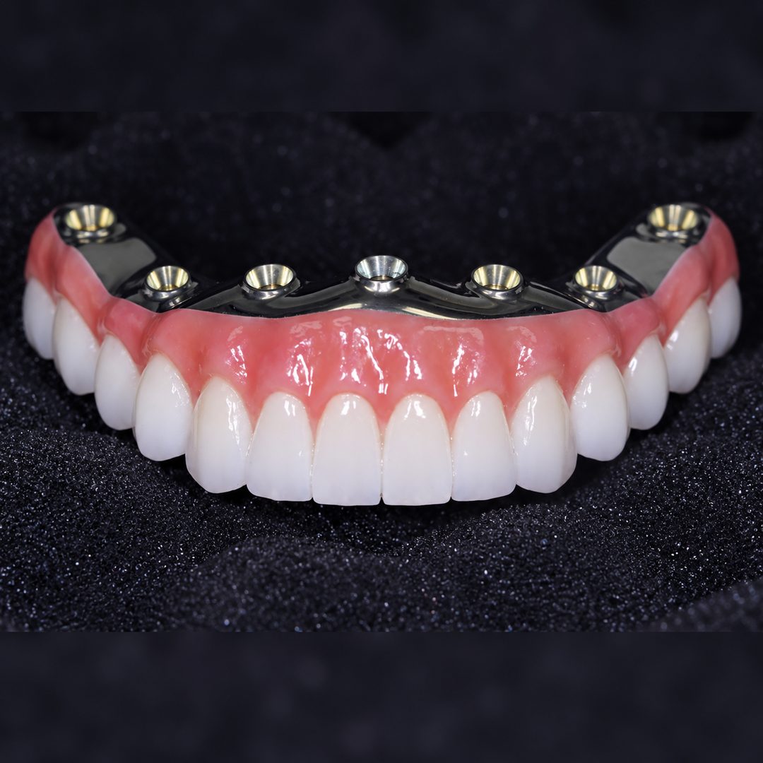 Full-arch implant bridge ready to be fitted