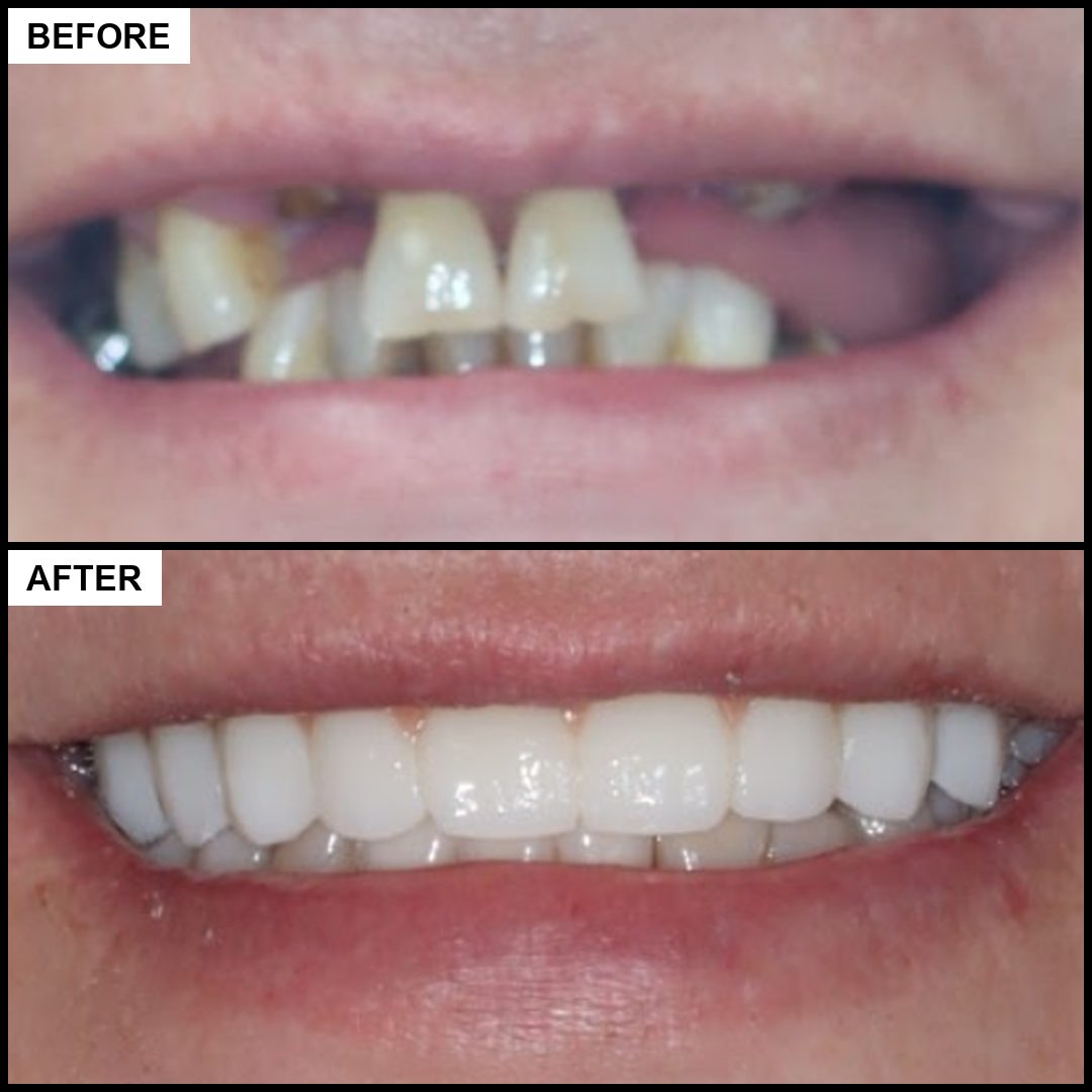 Before and after: missing and failing upper teeth replaced with a full smile