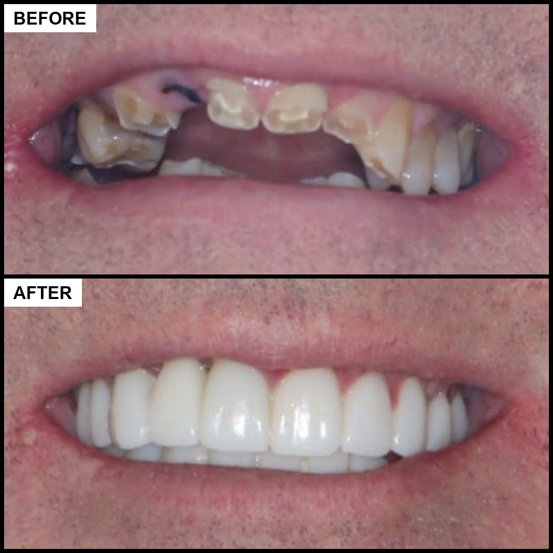 Before and after: broken and missing front teeth restored