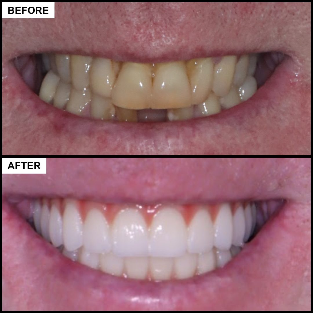 Before and after: worn, discoloured teeth replaced with a brighter smile