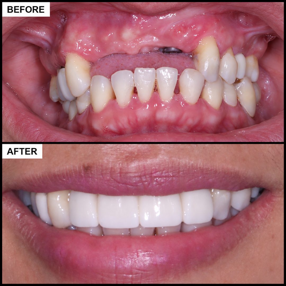 Before and after: missing upper front teeth replaced